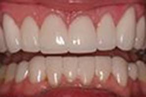 Closeup of repaired front teeth