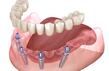 Digital diagram of dental implant supported dentures in Columbia