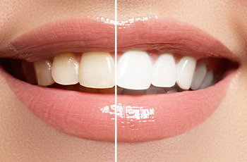 Before and after teeth whitening in Columbia, TN