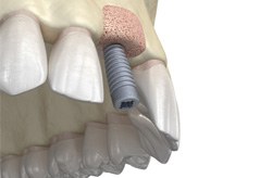 Illustration of dental implant in Columbia, TN placed after bone grafting