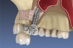 Illustration of dental implants in Columbia, TN placed after a sinus lift