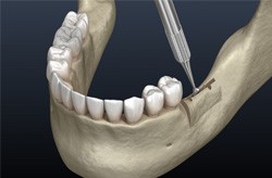 : Illustration of ridge expansion for the lower jaw