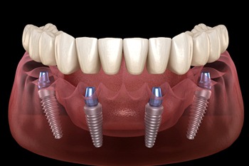 3D illustration of All-on-4 dental implants