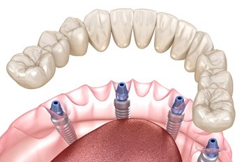 Digital illustration of all-on-4 dental implants