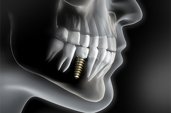 dental implant x-ray