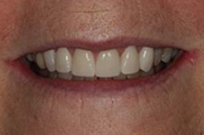 Closeup of repaired front teeth