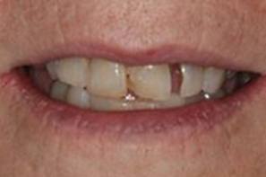 Closeup of broken front teeth