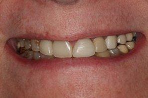 Damaged and decayed tooth