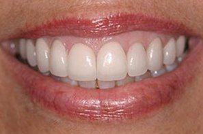 Woman with repaired white smile