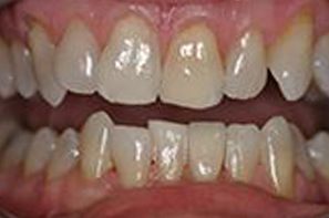 Closeup of discolored and damaged front teeth