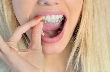 Closeup of woman placing her ClearCorrect clear aligners in Columbia
