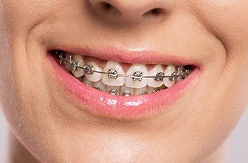 Closeup of teeth with braces