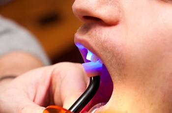 Curing light being used after dental bonding placement