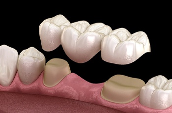 Digital illustration of dental bridge in Columbia