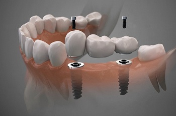 Digital illustration of implant bridge in Columbia