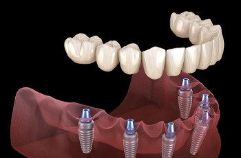 Digital illustration of dental implant supported dentures in Columbia on dark background