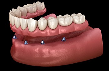 A 3D illustration of all-on-4 dentures