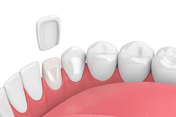 Illustration of veneer being placed on tooth