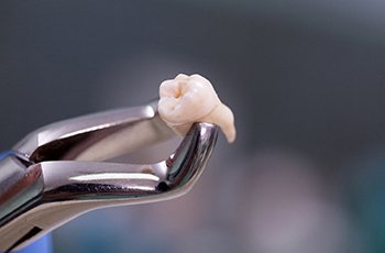 Extracted tooth in Columbia