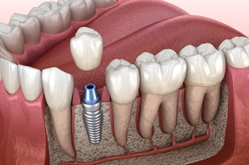 single dental implant being placed in the lower jaw