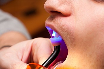 curing light being used to harden tooth-colored filling