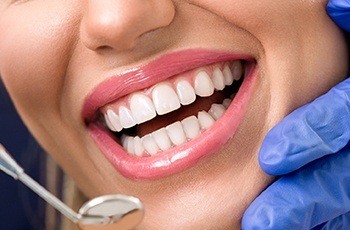 Closeup of gorgeous smile with porcelain veneers
