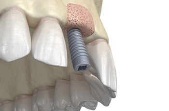 Dental implant placed in jaw after bone grafting in Columbia, TN 