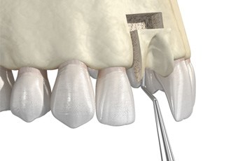 Render of bone grafting in Columbia, TN for upper arch 