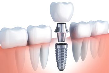 Illustration of dental implants