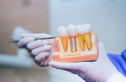 Dentist holding a model of dental implants in Columbia 