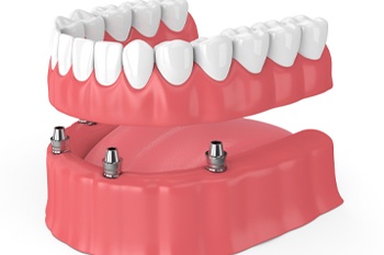 Image of a lower denture being attached to implants