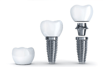 dental implants