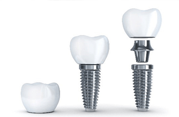 Closeup of parts of dental implants in Columbia