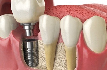 Diagram of how dental implants in Columbia work