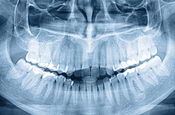 X-ray of mouth before getting dental implants in Columbia