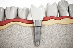 Diagram of how dental implants work in Columbia