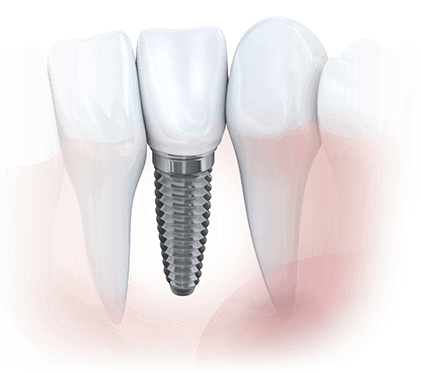 Dental Implant