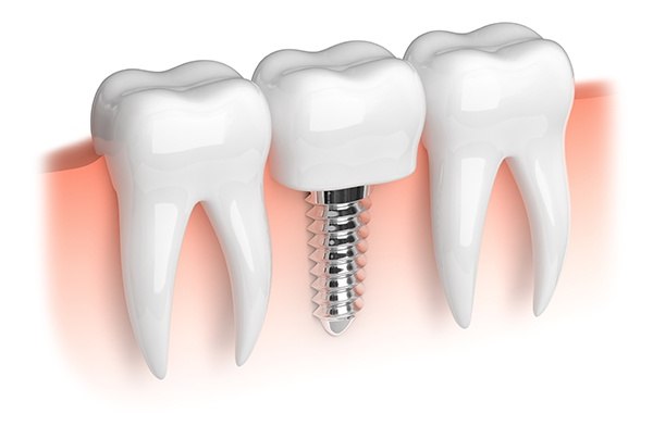 Animated smile with dental implant supported dental crown