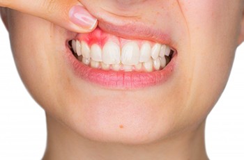 closeup of person pointing to their red inflamed gums before periodontal therapy
