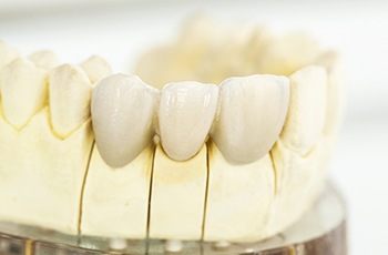 Model smile with dental crown supported fixed bridge