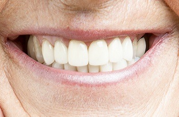 Closeup of smile with dentures