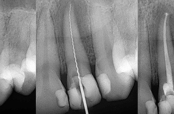 X-ray of tooth during root canal treatment covered by dental insurance