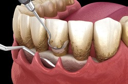 3D render of a root planing