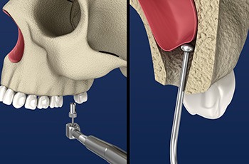 Illustration of sinus lift surgery