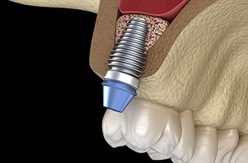 Dental implant placed after a sinus lift