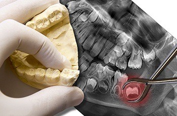 X-ray of wisdom teeth prior to extractions