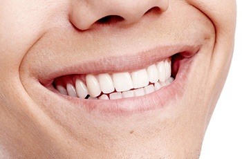Closeup of flawless smile after gum graft