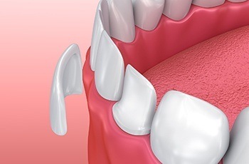 Animated smile during porcelain veneer placement