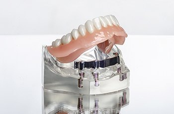Done in one dental implant dentures on a plastic model