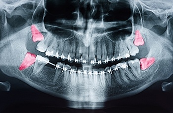 x-ray of impacted wisdom teeth